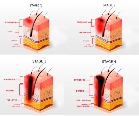 How to Prevent Bed Sores in Bedridden Patients- Methods & Care Product